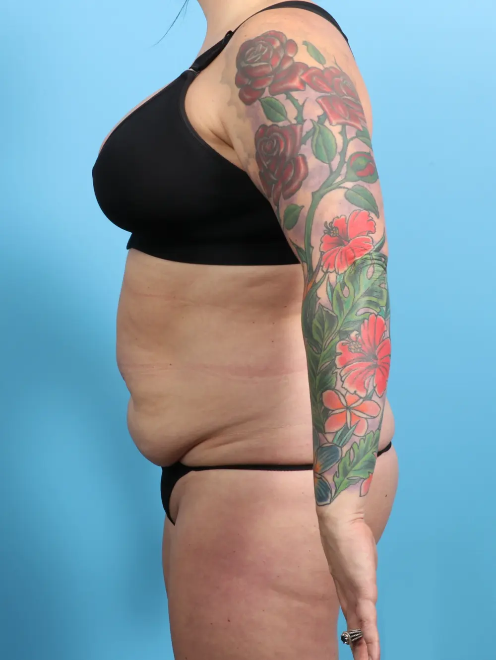 Tummy Tuck Patient Photo - Case 24163 - before view-2