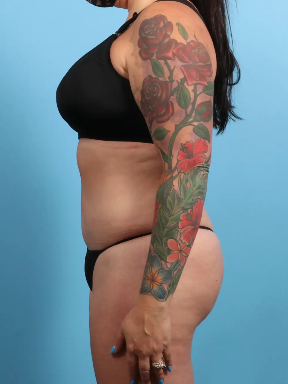 Tummy Tuck Patient Photo - Case 24163 - after view-2