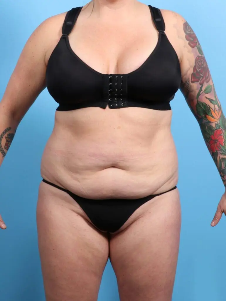 Tummy Tuck - Case 24163 - Before