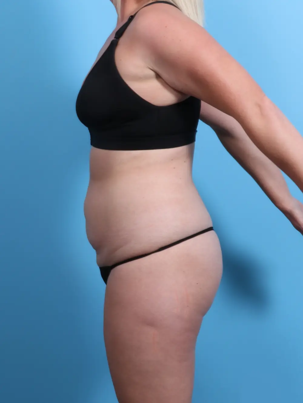 Tummy Tuck Patient Photo - Case 24187 - before view-2