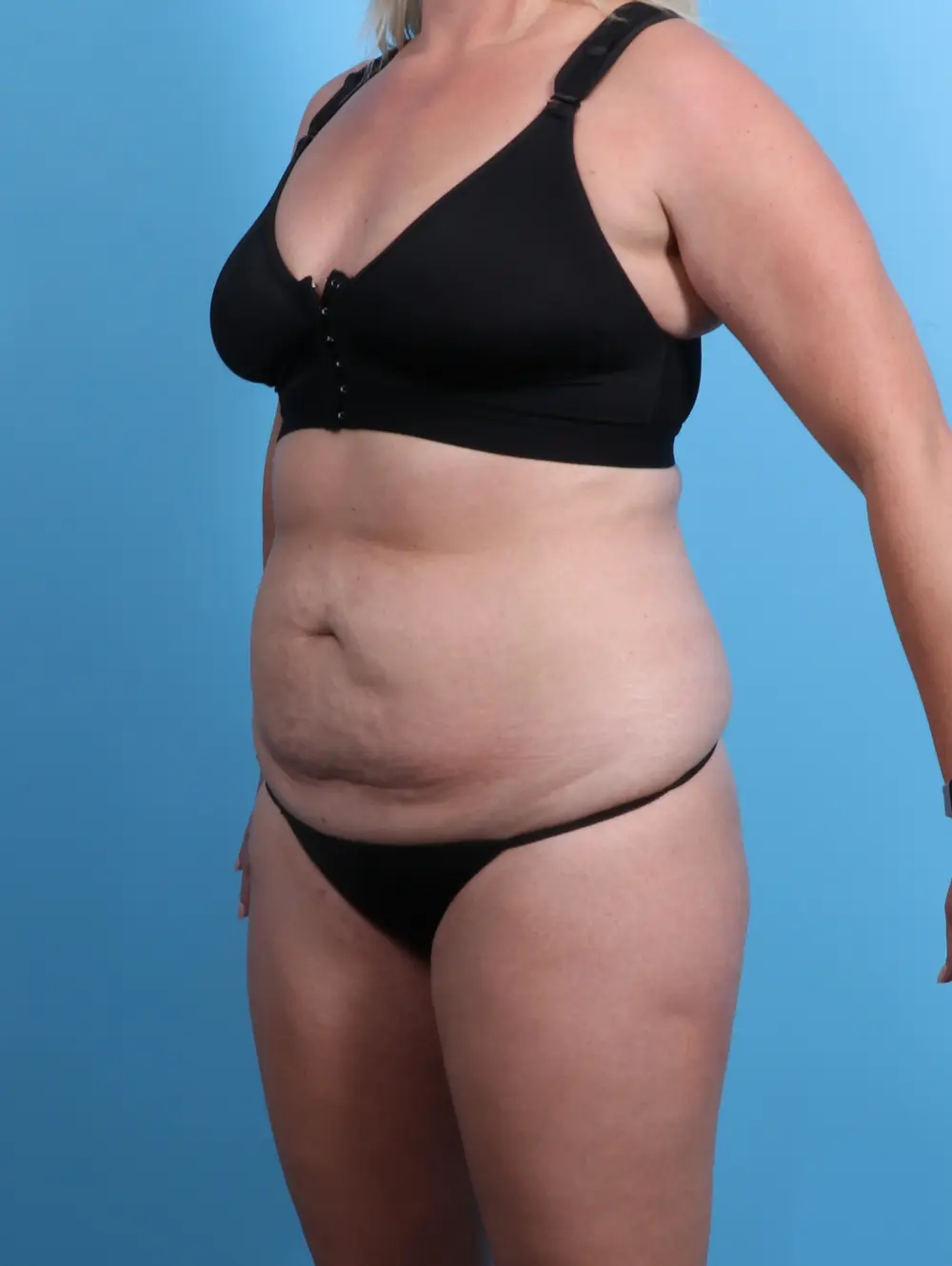 Tummy Tuck Patient Photo - Case 24187 - before view-1