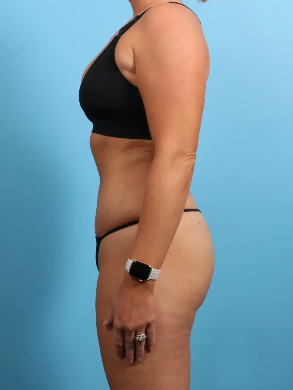 Tummy Tuck Patient Photo - Case 24187 - after view-2