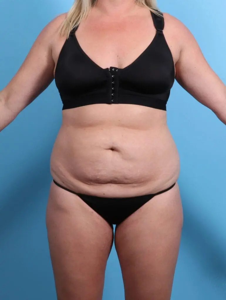 Tummy Tuck - Case 24187 - Before