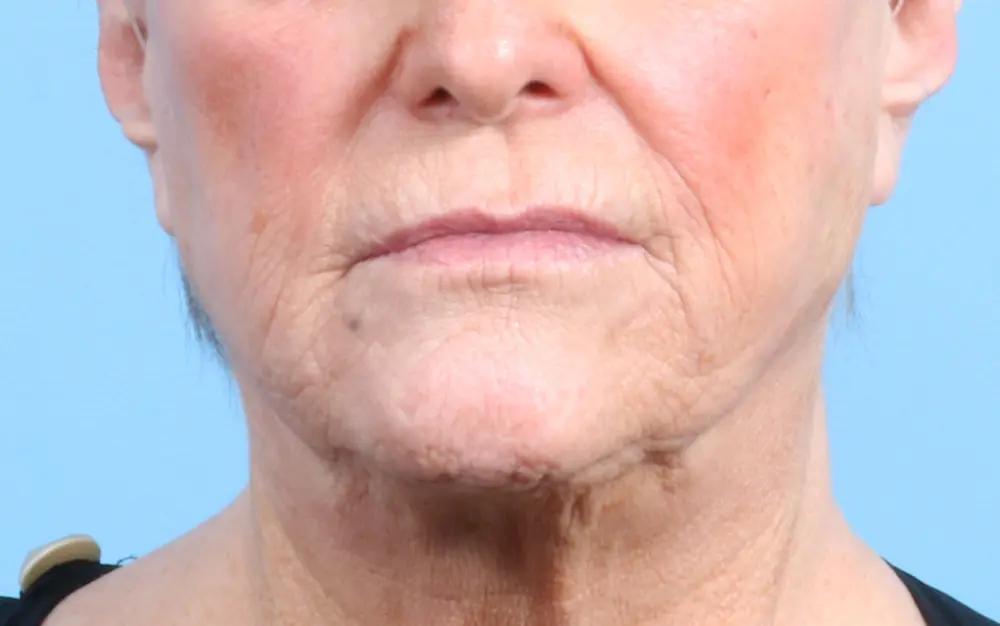 Laser Resurfacing - Case 24203 - Before