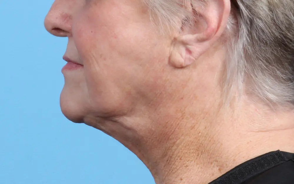 Laser Resurfacing Patient Photo - Case 24203 - after view-1