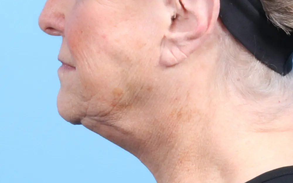 Laser Resurfacing Patient Photo - Case 24203 - before view-1