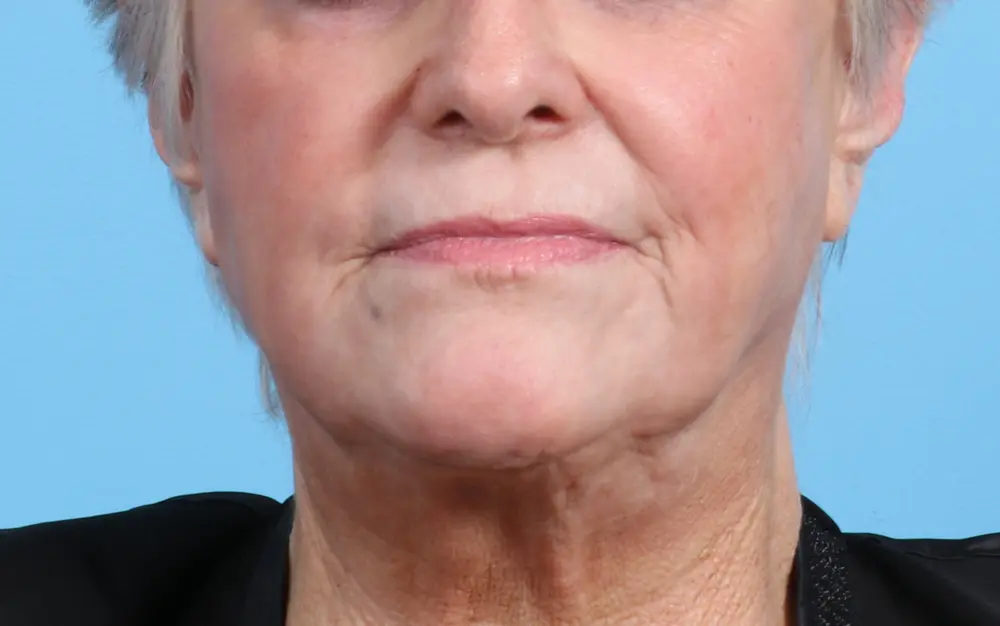 Laser Resurfacing - Case 24203 - After