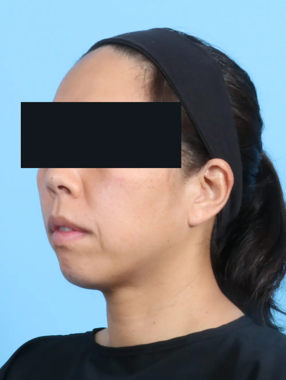 Chin Implant Patient Photo - Case 24220 - before view-1