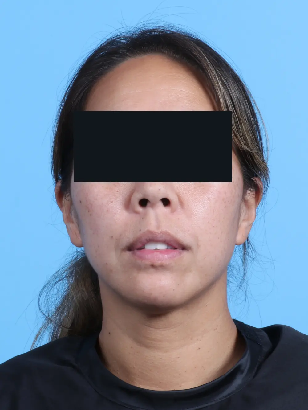 Chin Implant Patient Photo - Case 24220 - after view-2