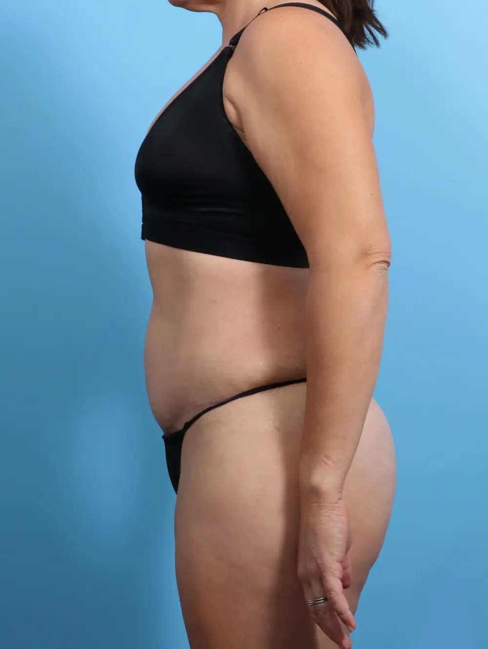 Tummy Tuck Patient Photo - Case 24270 - after view-2