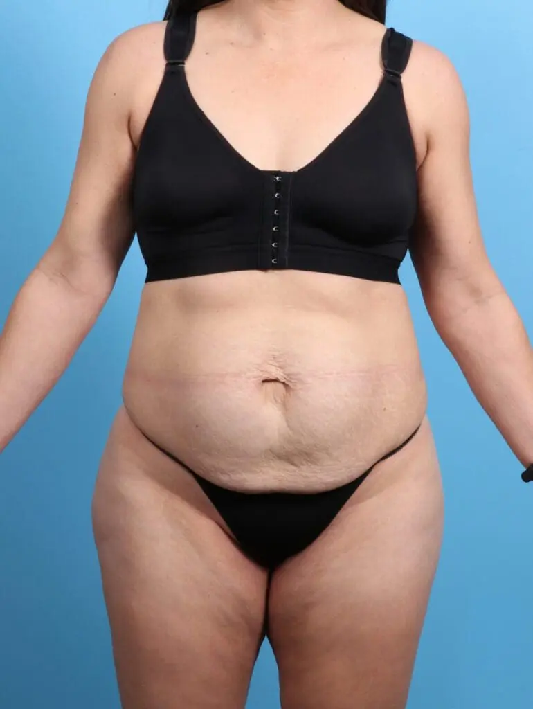 Tummy Tuck - Case 24270 - Before