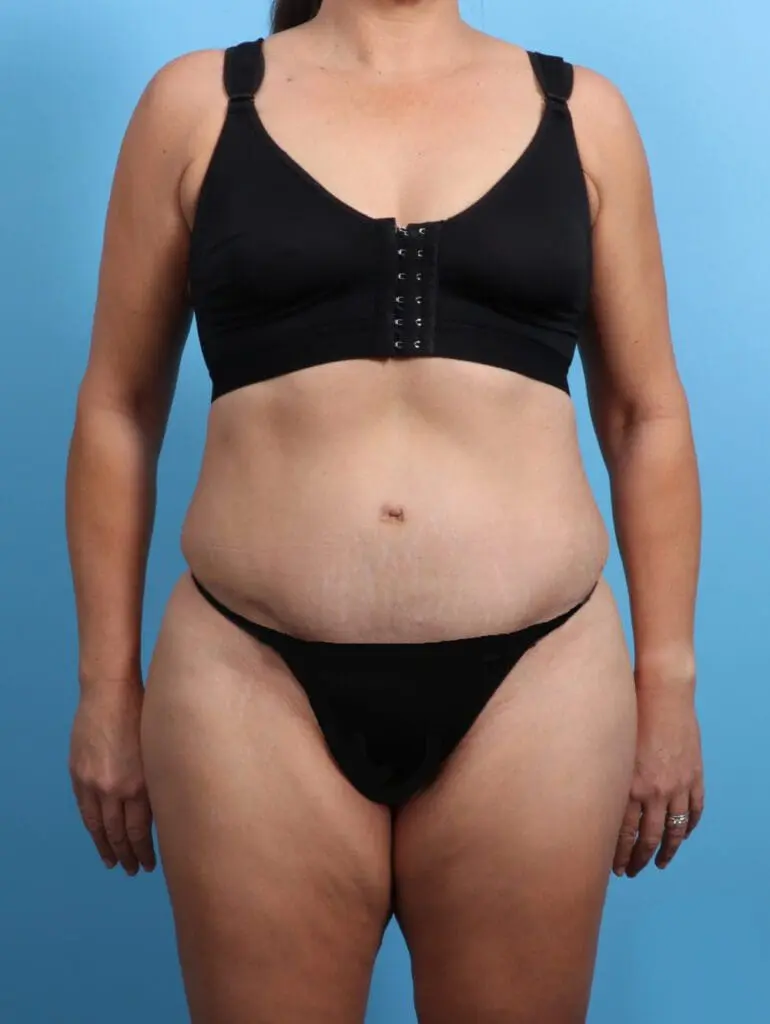 Tummy Tuck - Case 24270 - After