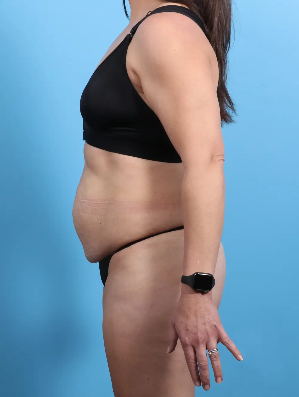 Tummy Tuck Patient Photo - Case 24270 - before view-2
