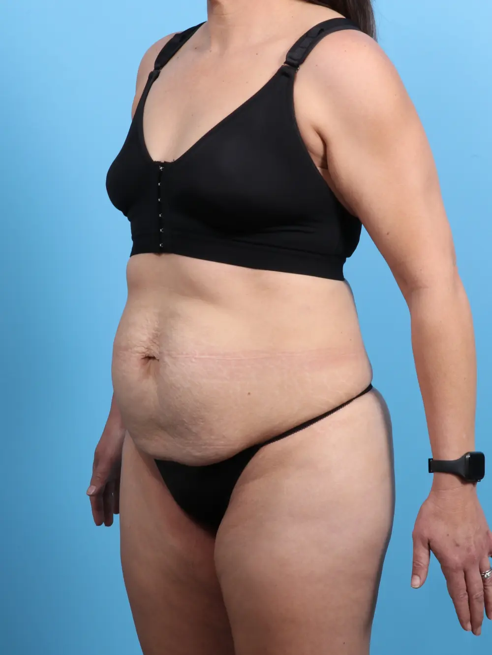 Tummy Tuck Patient Photo - Case 24270 - before view-1