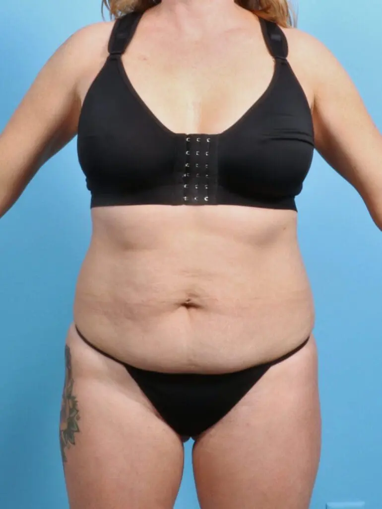 Tummy Tuck - Case 24278 - Before