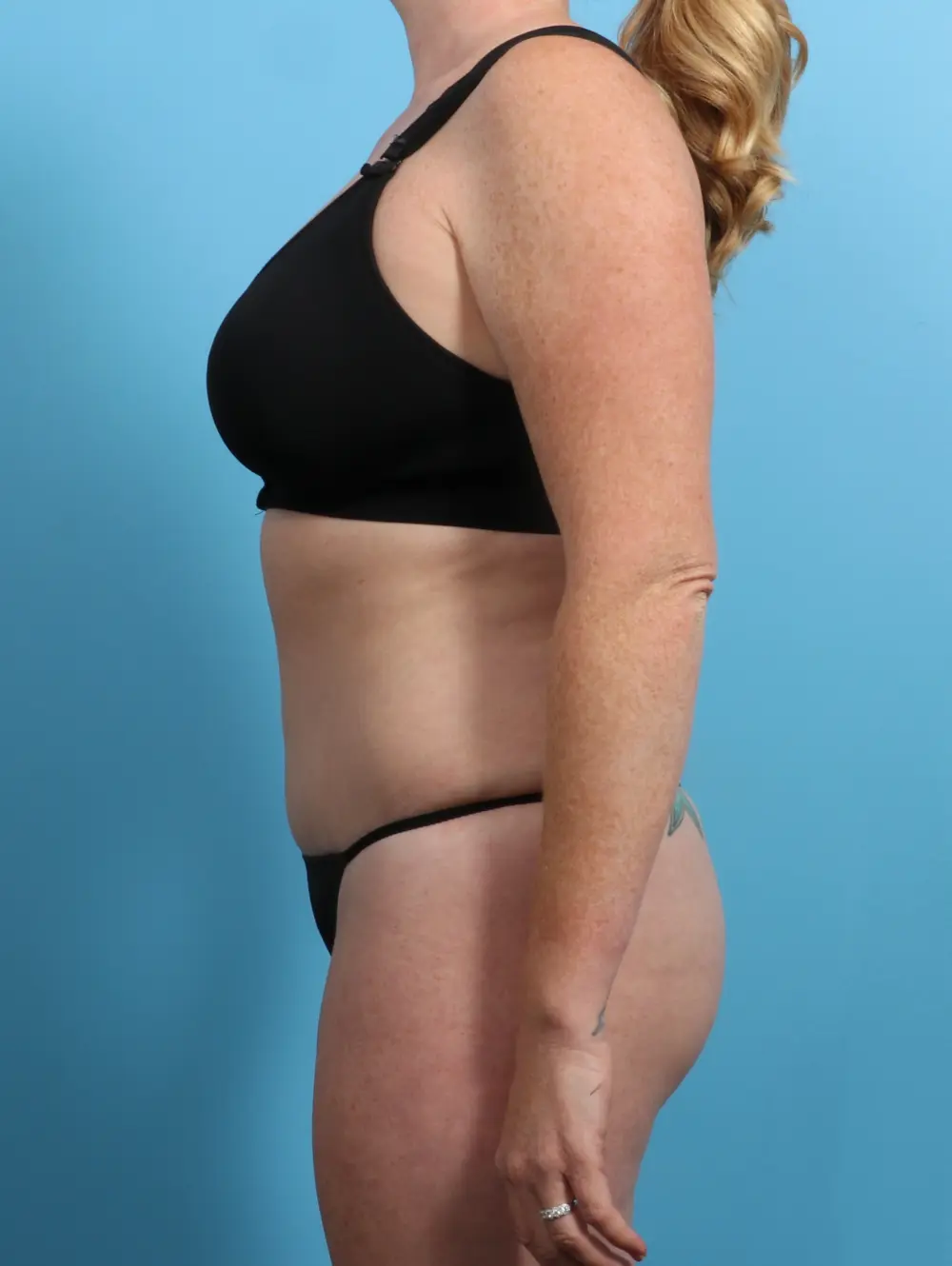 Tummy Tuck Patient Photo - Case 24278 - after view-2