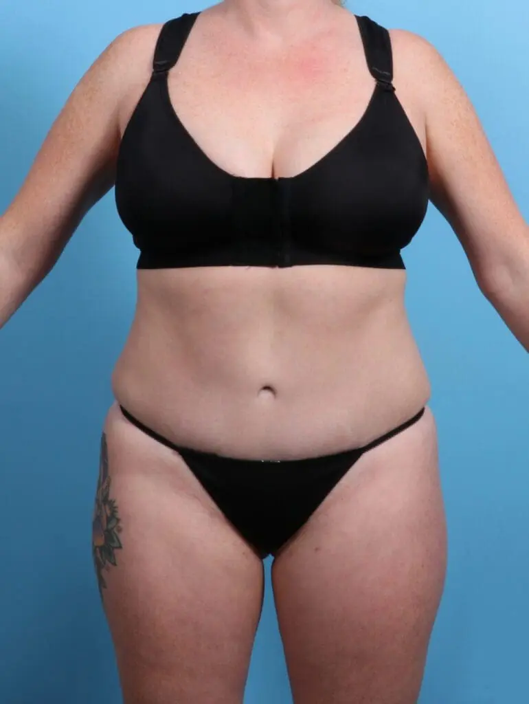 Tummy Tuck - Case 24278 - After