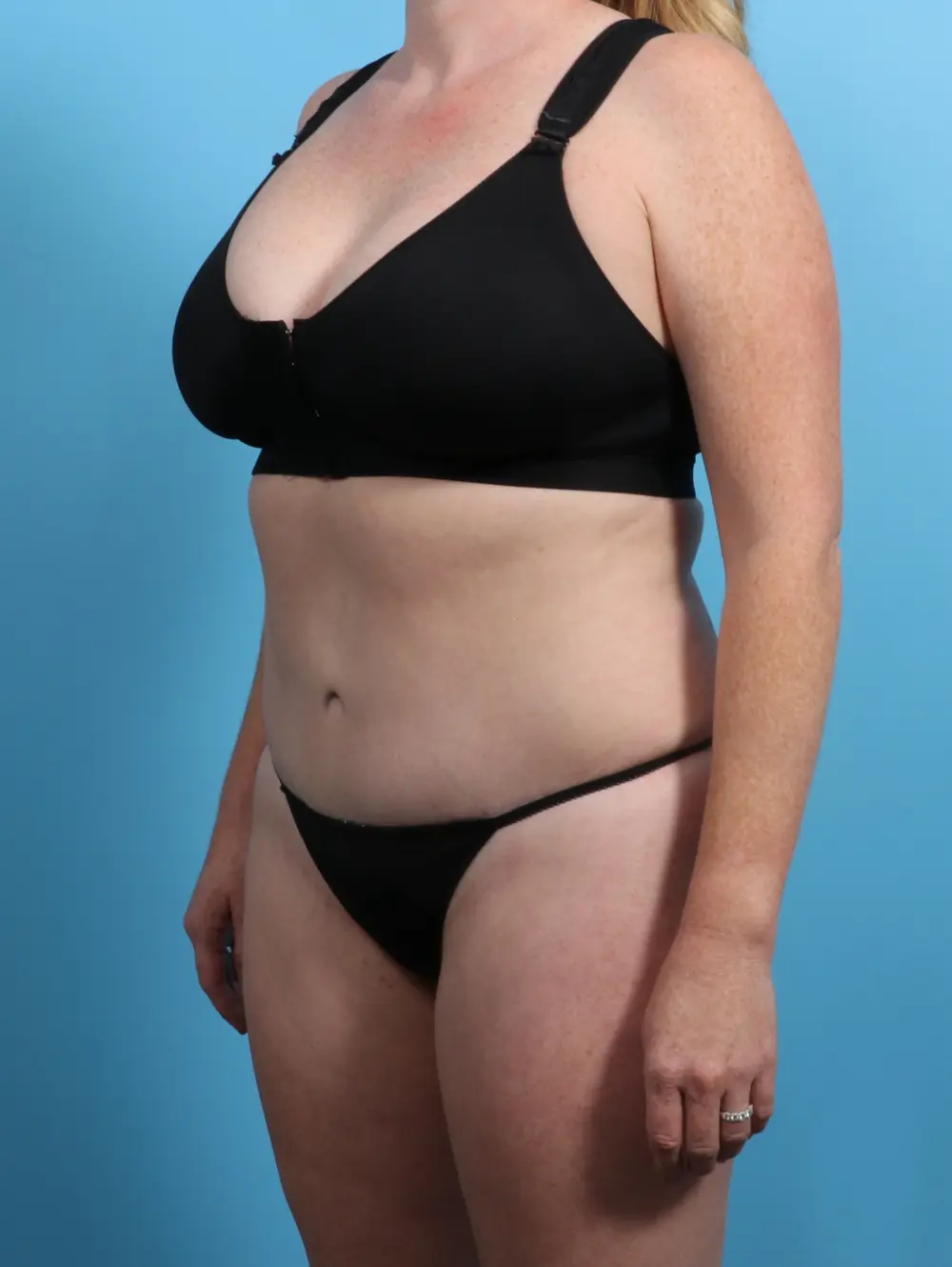 Tummy Tuck Patient Photo - Case 24278 - after view-1
