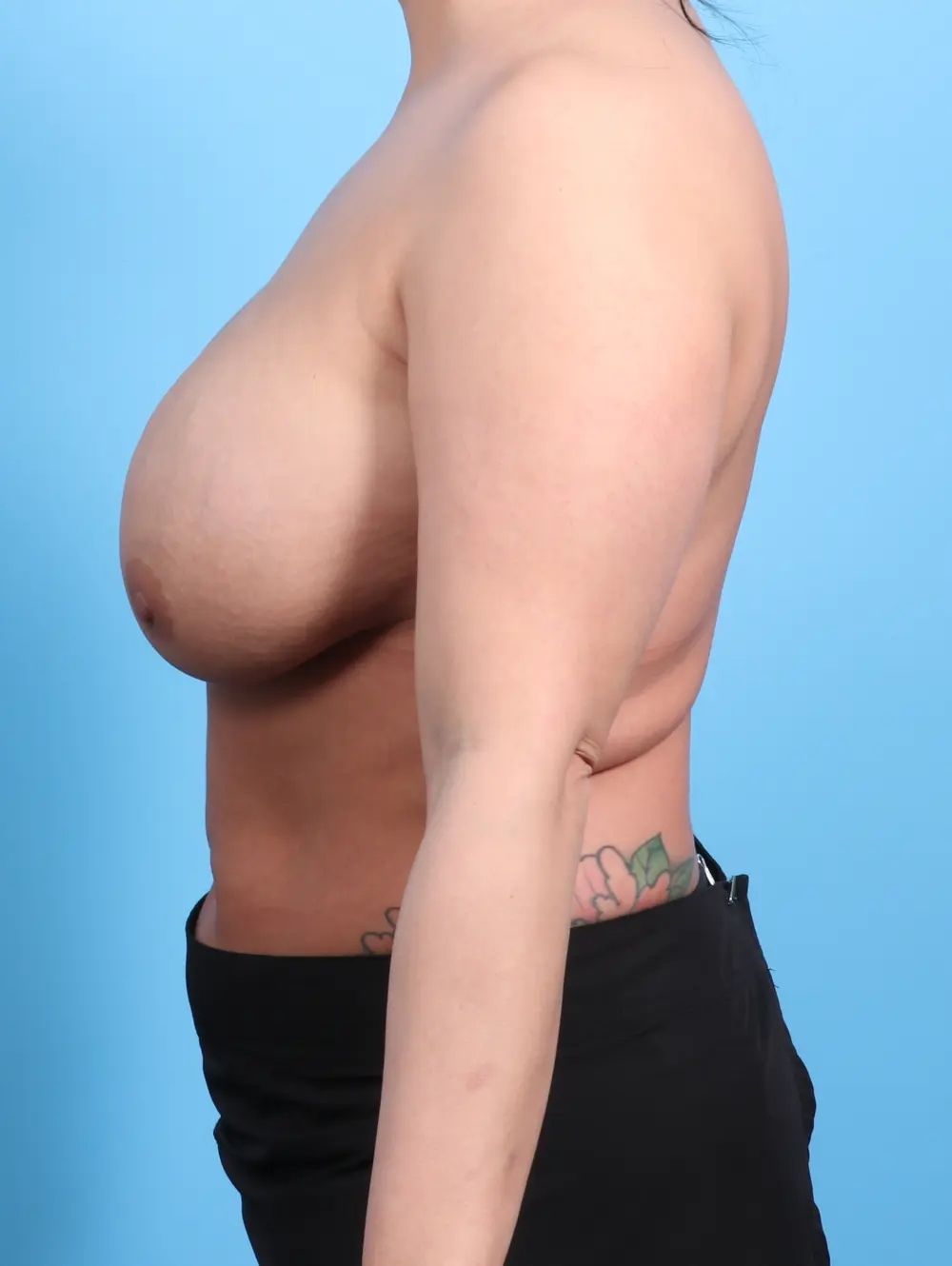 Breast Implant Revision Patient Photo - Case 24287 - before view-2
