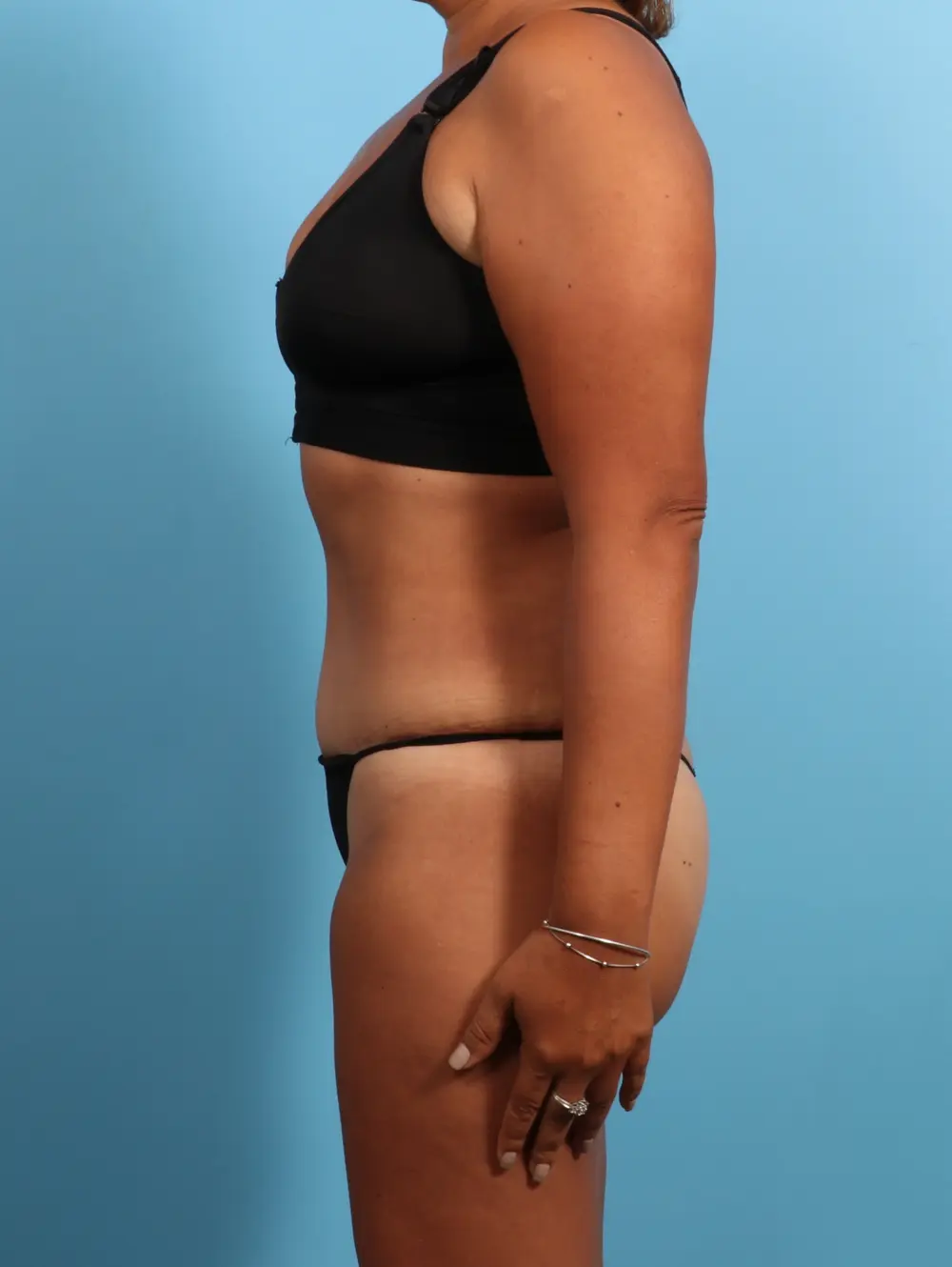 Tummy Tuck Patient Photo - Case 24297 - after view-2