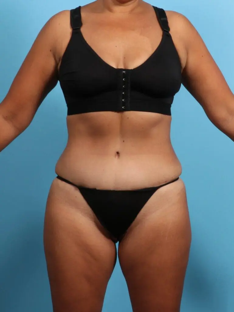 Tummy Tuck - Case 24297 - After