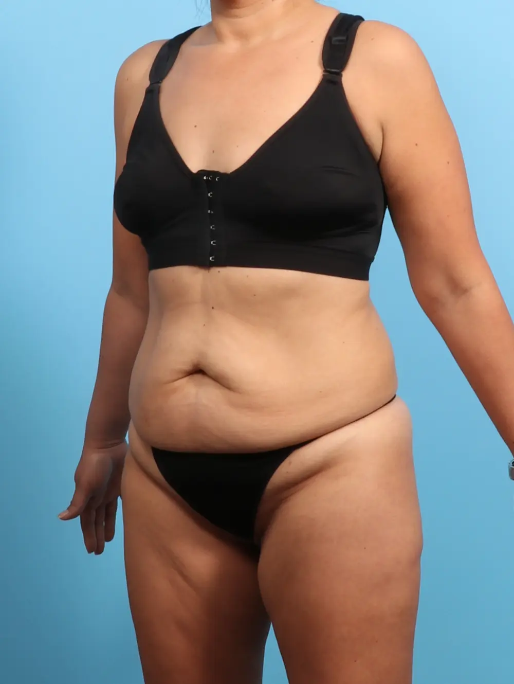 Tummy Tuck Patient Photo - Case 24297 - before view-1