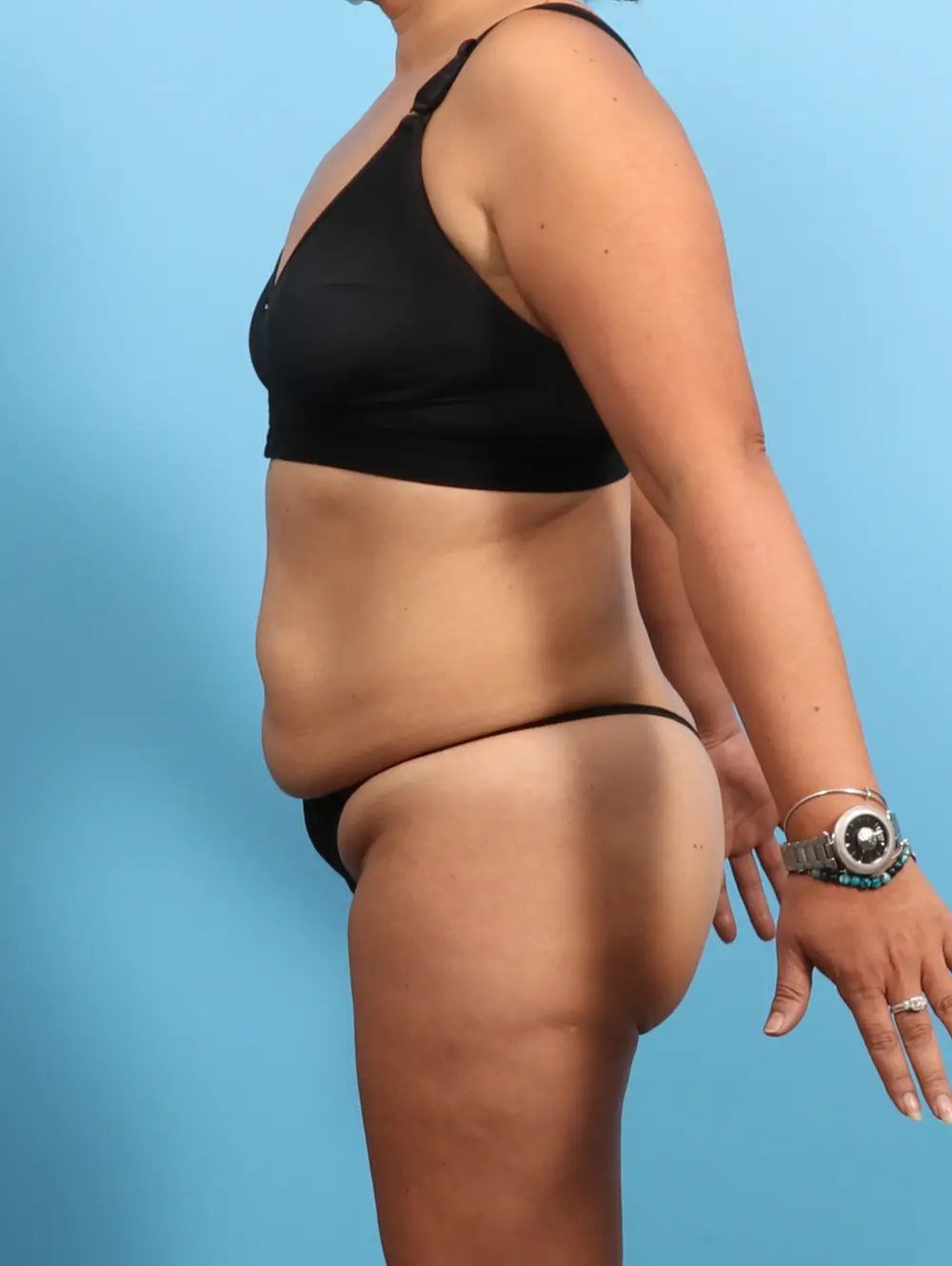 Tummy Tuck Patient Photo - Case 24297 - before view-2
