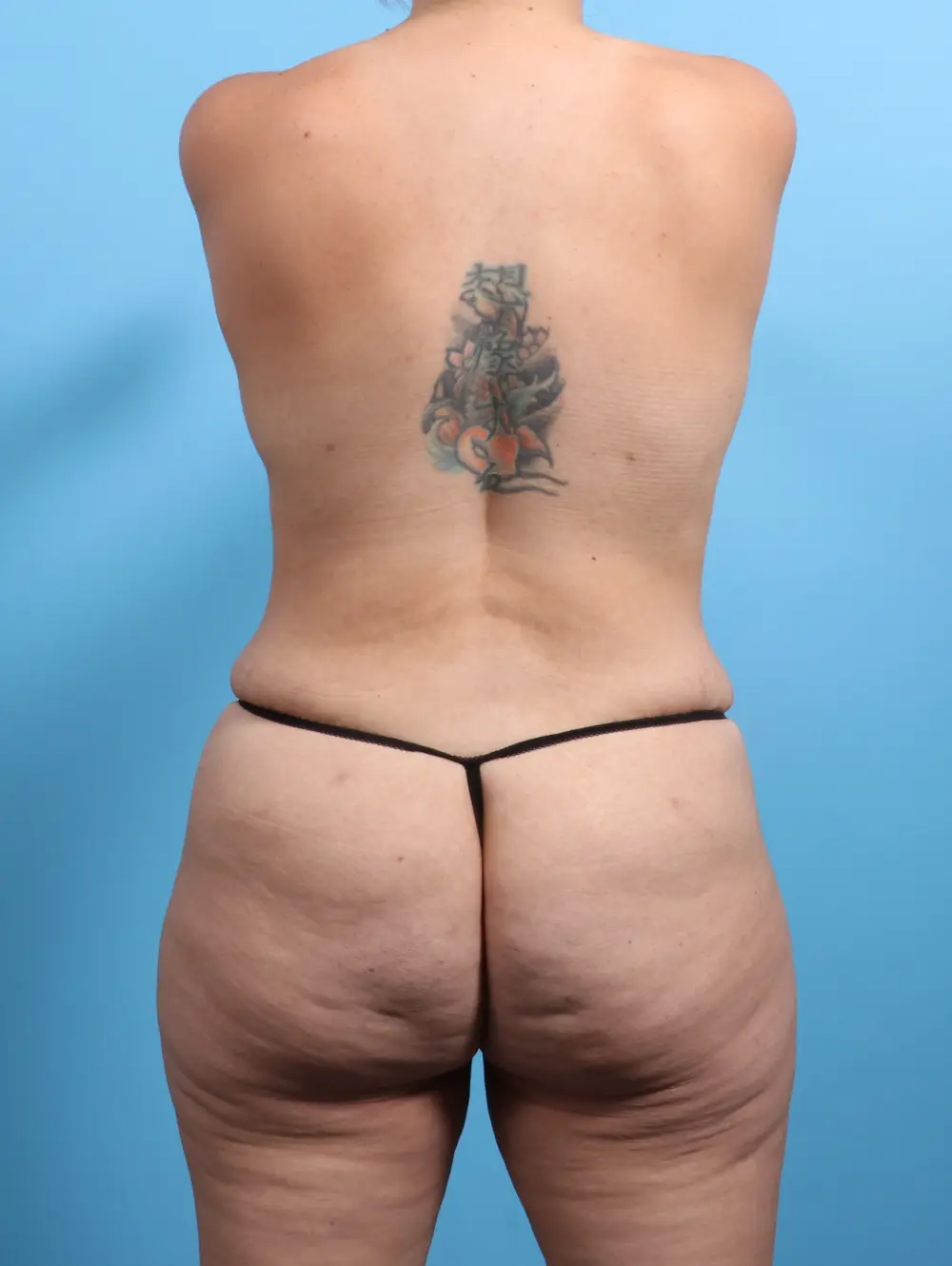 After Weight Loss Patient Photo - Case 24324 - after view-3