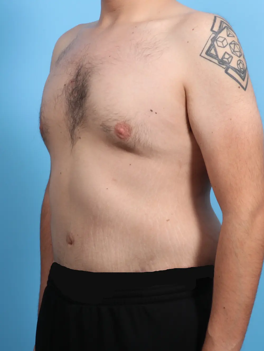 After Weight Loss Patient Photo - Case 24342 - after view-1