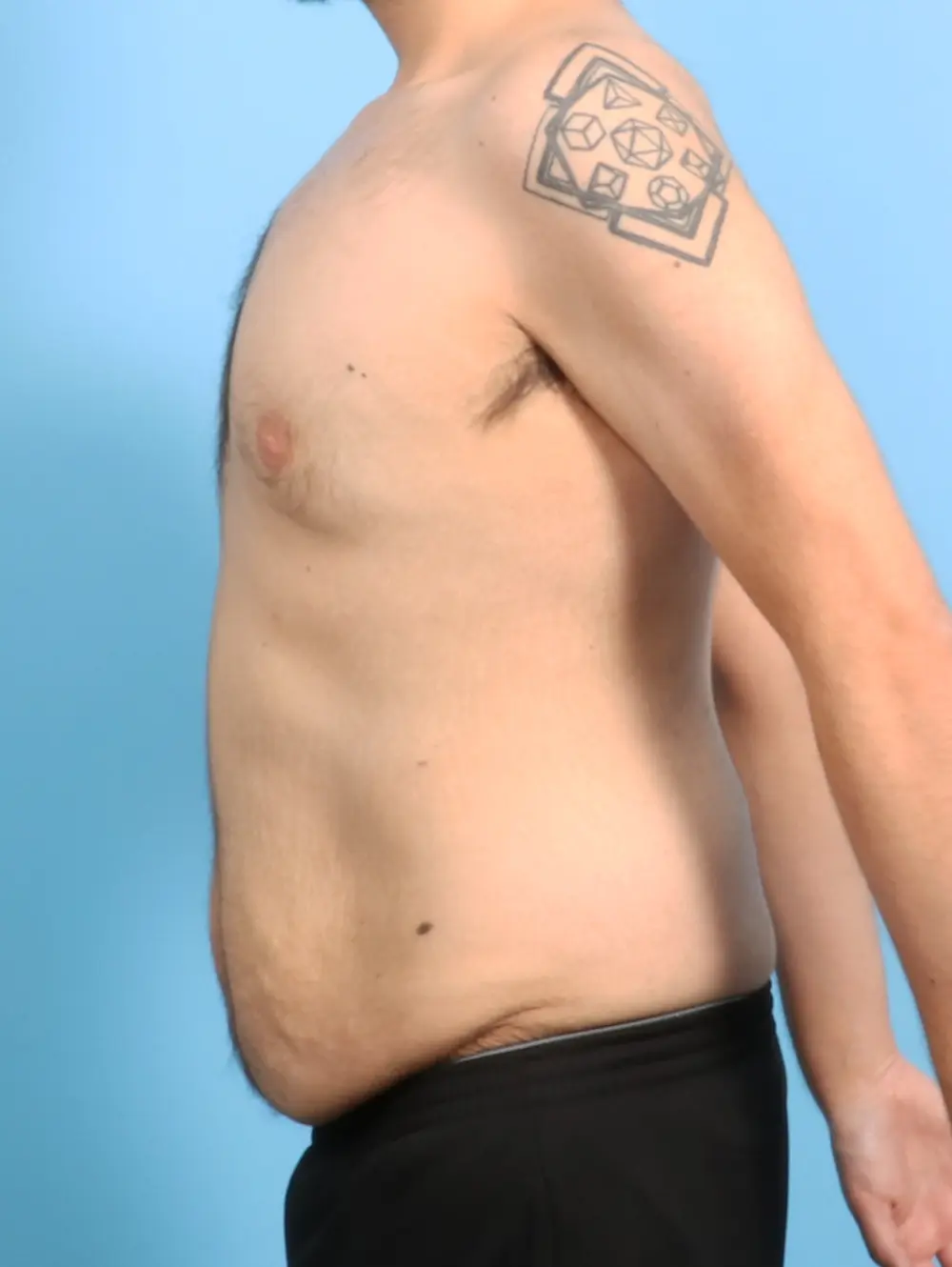 After Weight Loss Patient Photo - Case 24342 - before view-2