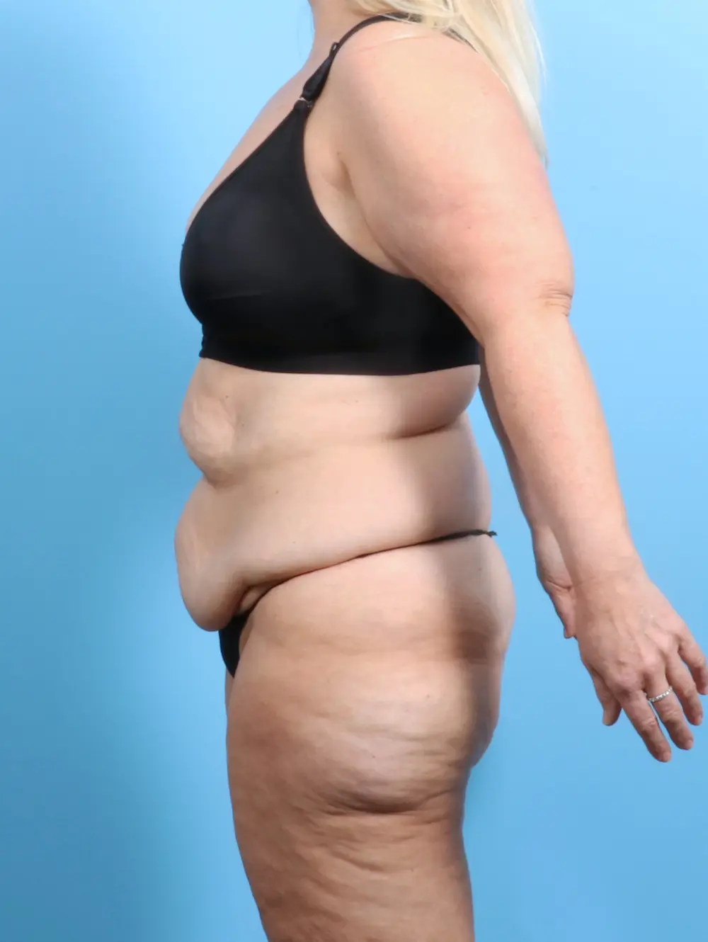 After Weight Loss Patient Photo - Case 24359 - before view-2