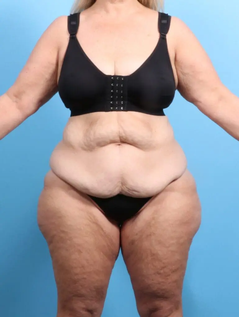 After Weight Loss - Case 24359 - Before