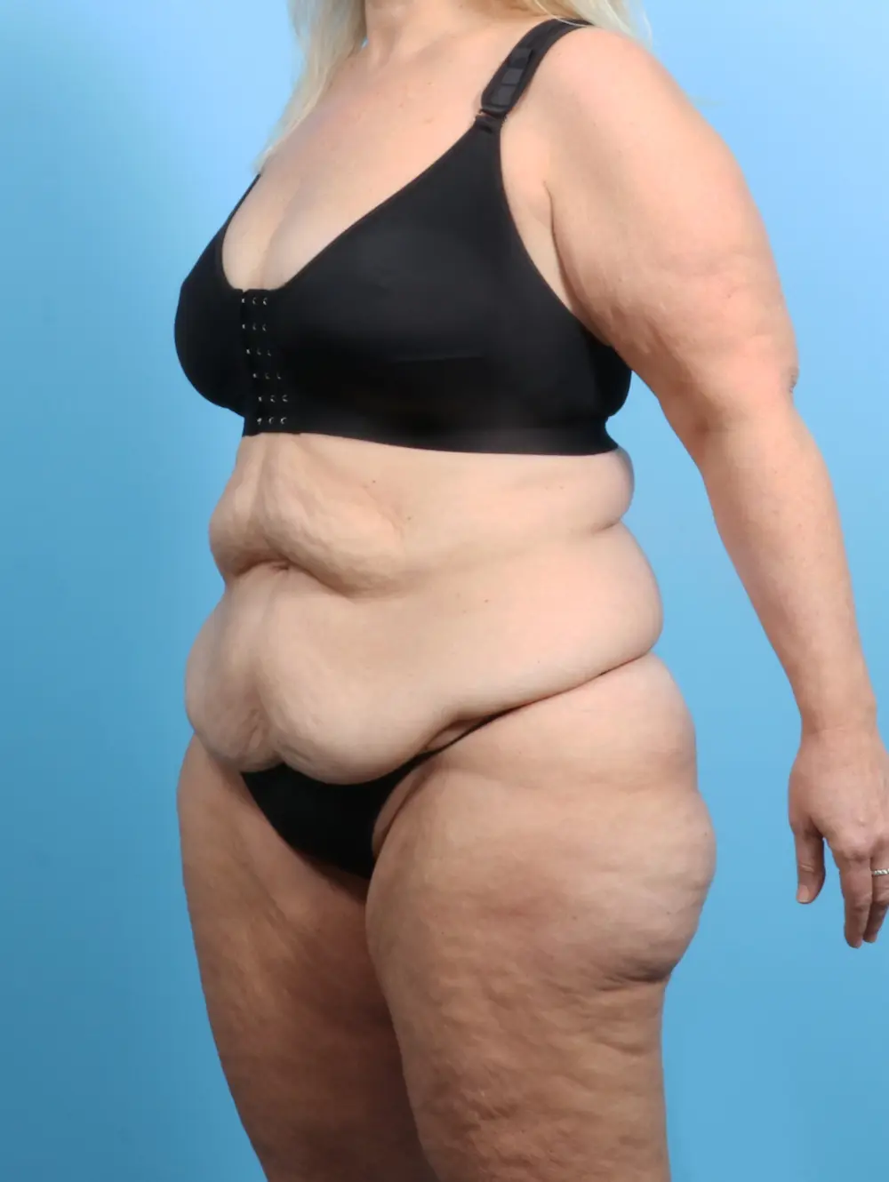 After Weight Loss Patient Photo - Case 24359 - before view-1