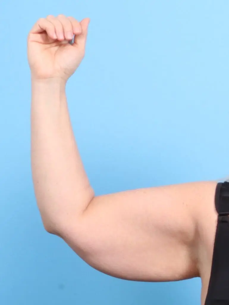 Arm Lift - Case 24369 - After