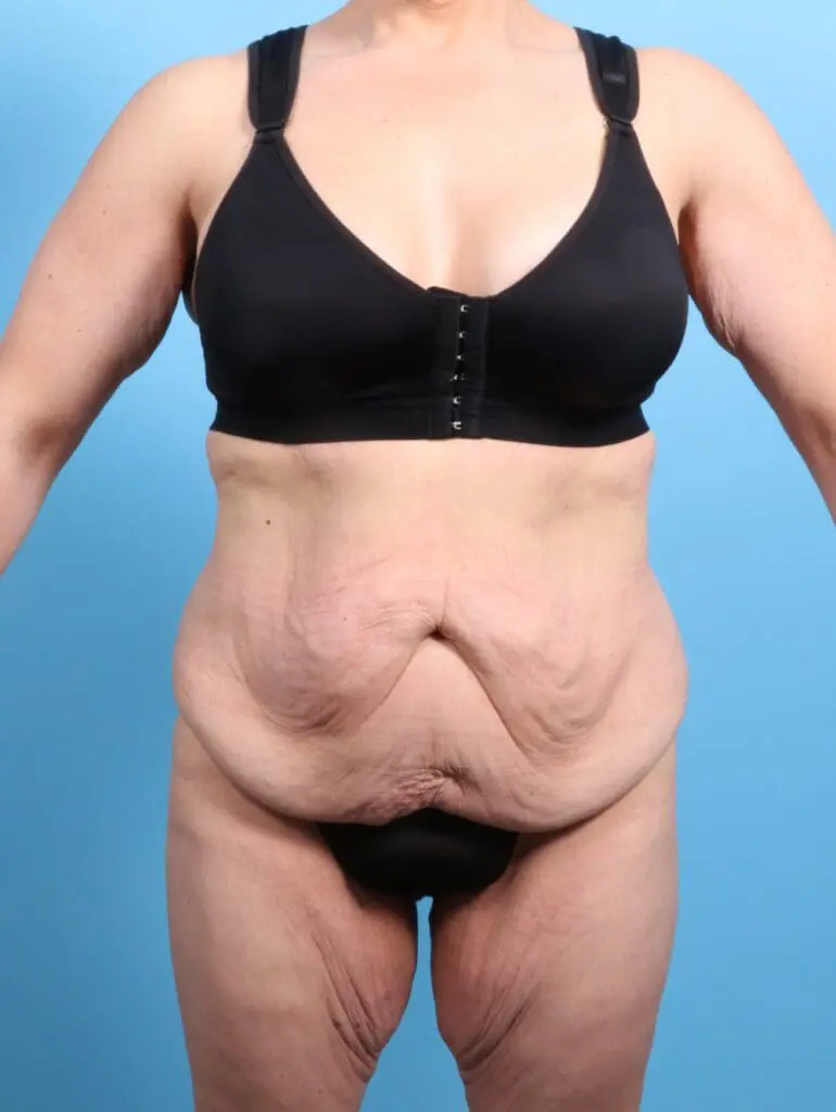 After Weight Loss - Case 24420 - Before