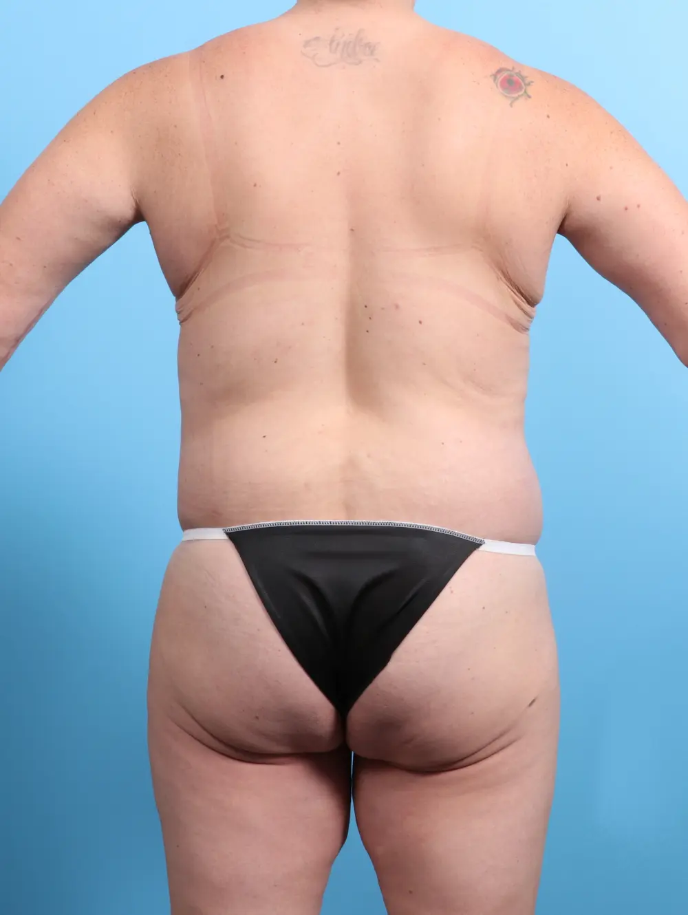 After Weight Loss Patient Photo - Case 24420 - after view-3