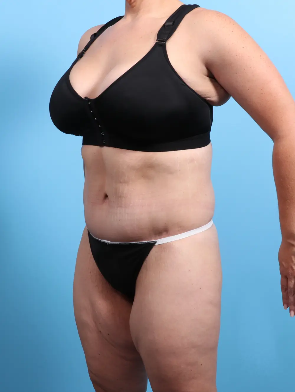 After Weight Loss Patient Photo - Case 24420 - after view-1