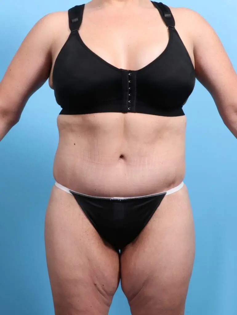 After Weight Loss - Case 24420 - After