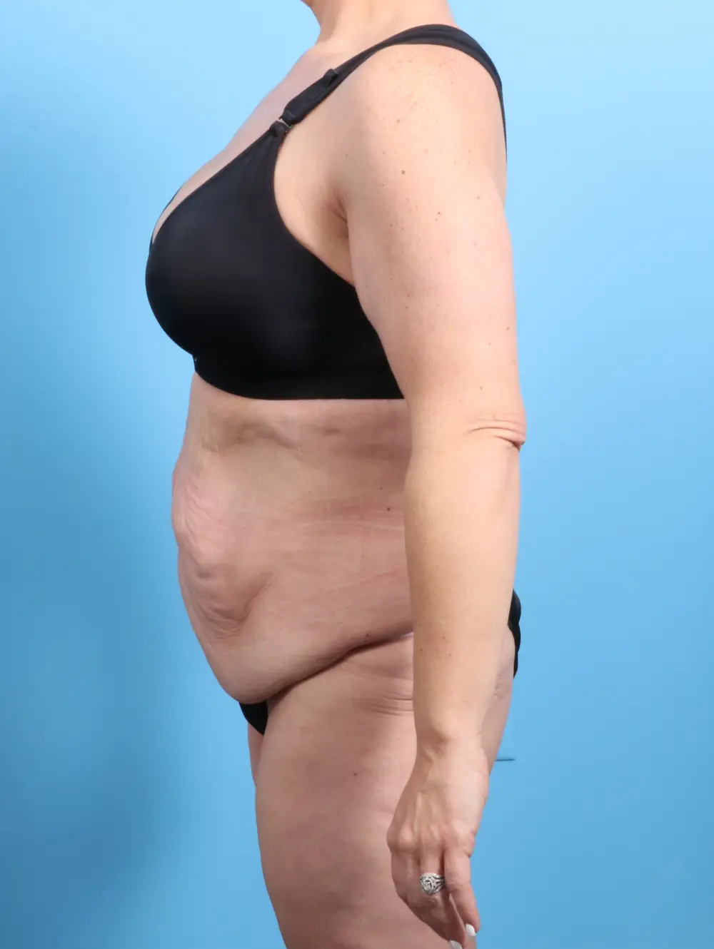After Weight Loss Patient Photo - Case 24420 - before view-2
