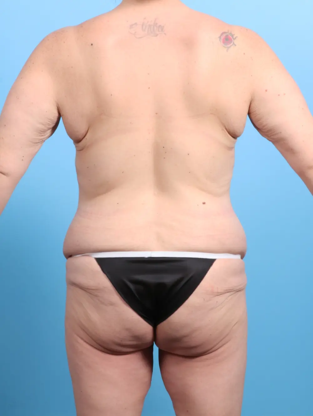 After Weight Loss Patient Photo - Case 24420 - before view-3