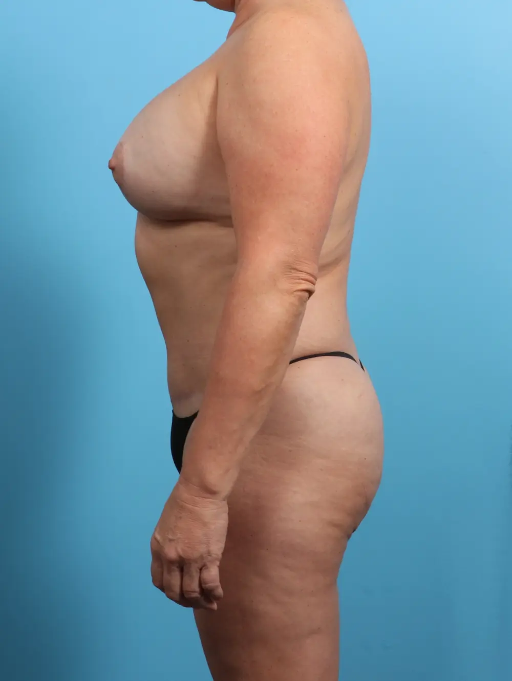 Breast Lift/Reduction with Implants Patient Photo - Case 24444 - after view-2