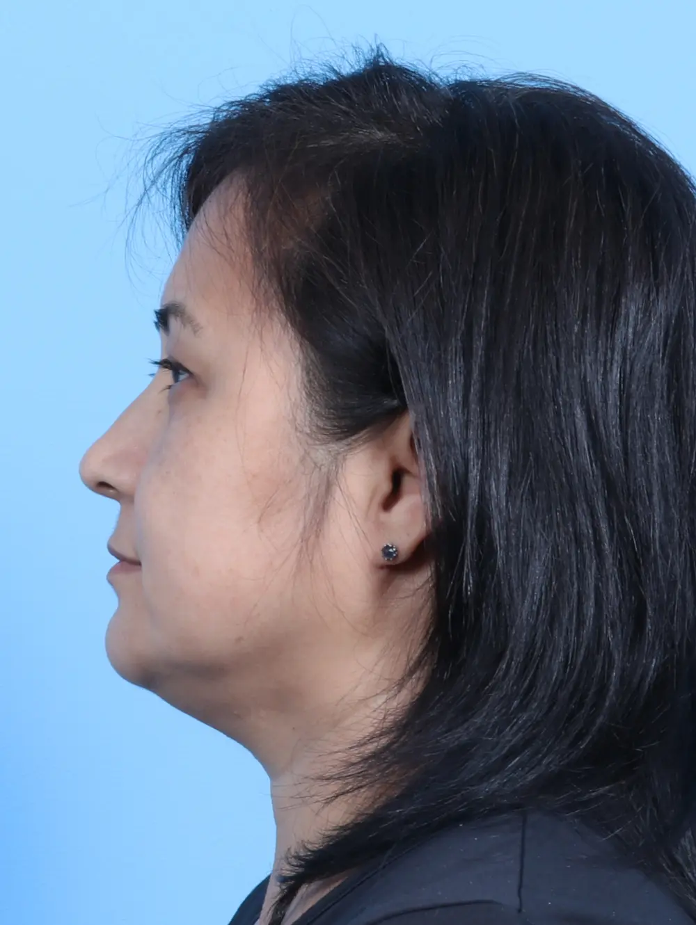 Eyelid Surgery Patient Photo - Case 24470 - before view-2