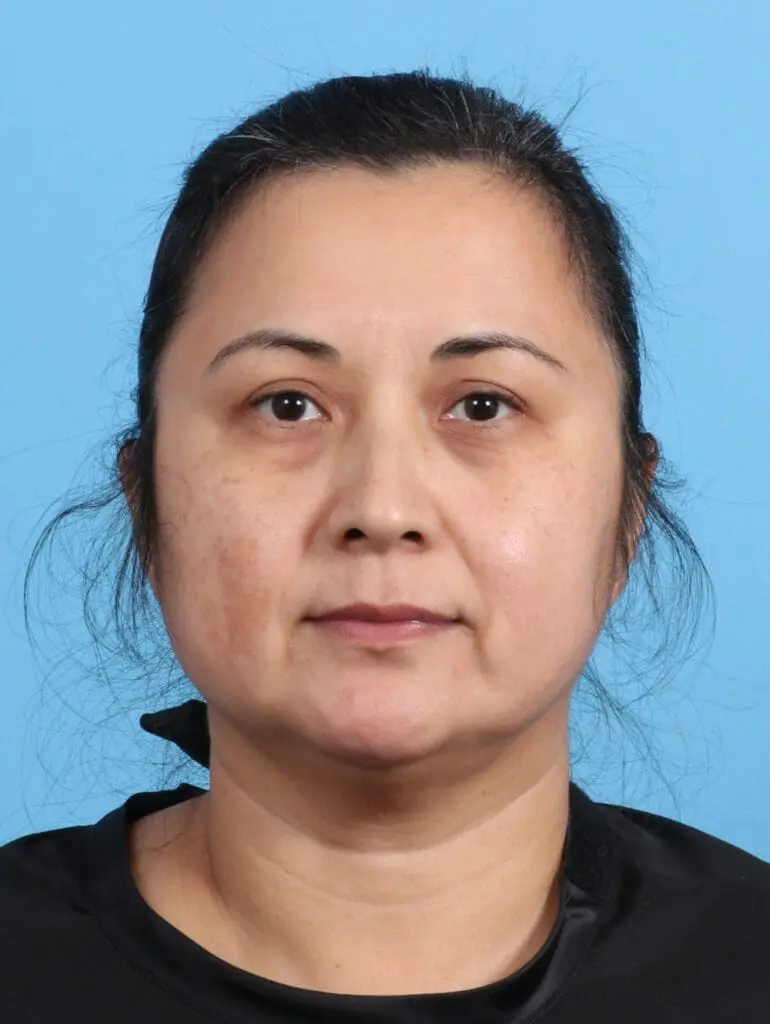 Eyelid Surgery - Case 24470 - After