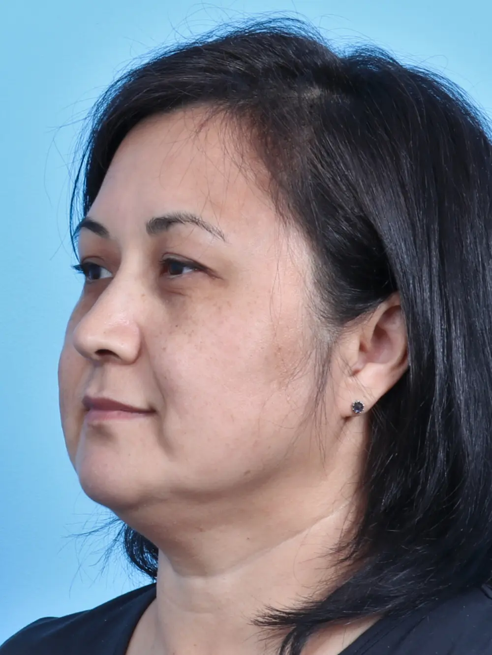 Eyelid Surgery Patient Photo - Case 24470 - before view-1