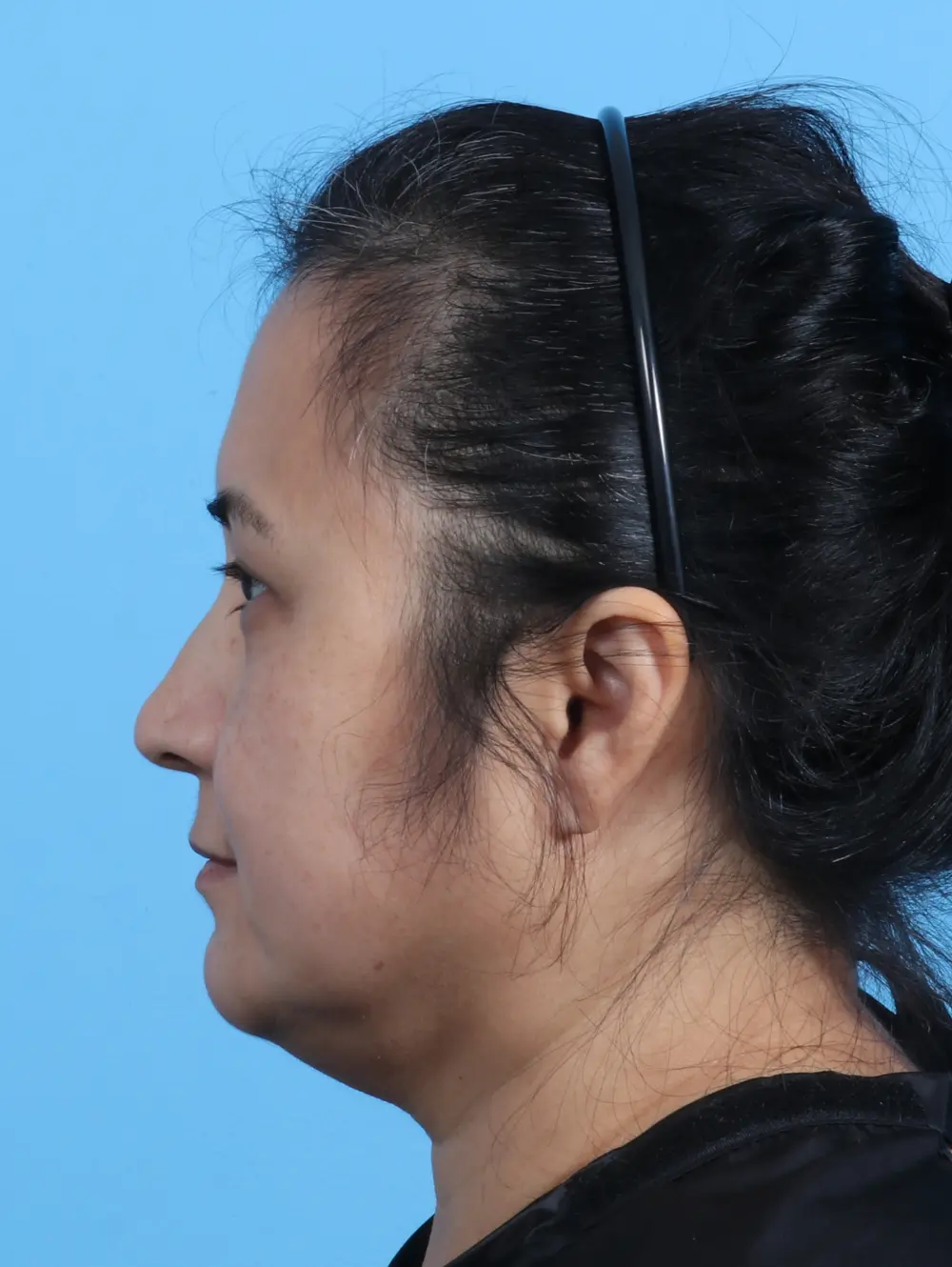 Eyelid Surgery Patient Photo - Case 24470 - after view-2