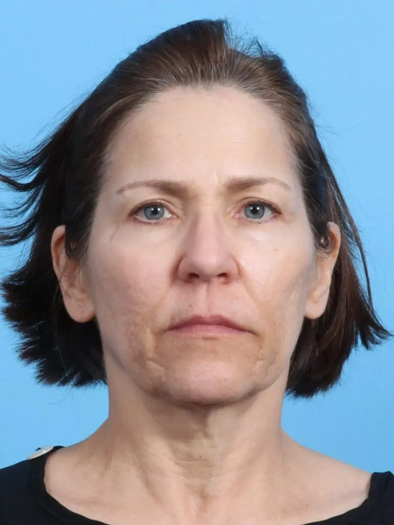 Facelift / Neck Lift - Case 24486 - Before