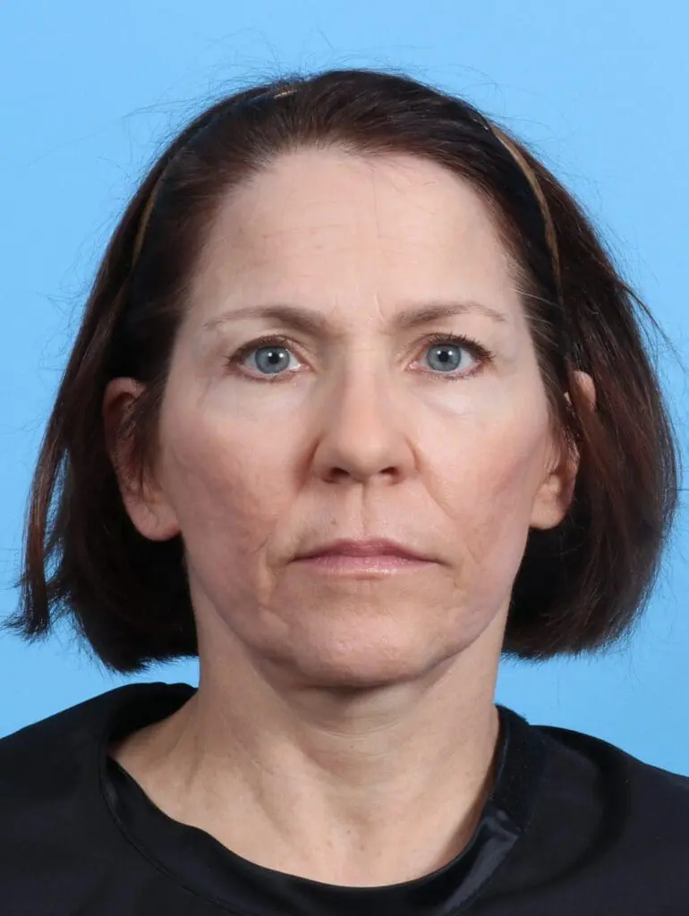 Facelift / Neck Lift - Case 24486 - After