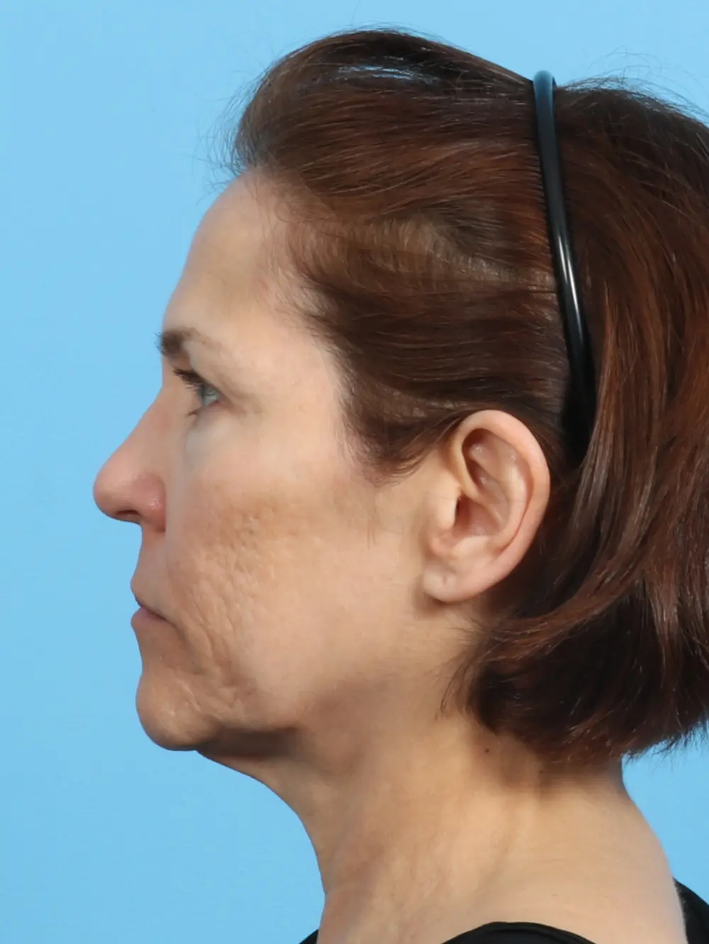 Facelift / Neck Lift Patient Photo - Case 24486 - before view-2
