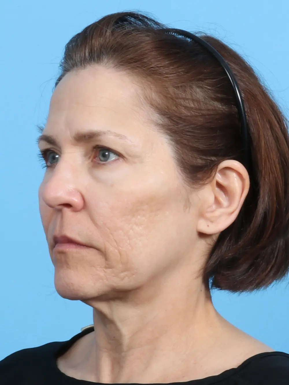 Facelift / Neck Lift Patient Photo - Case 24486 - before view-1