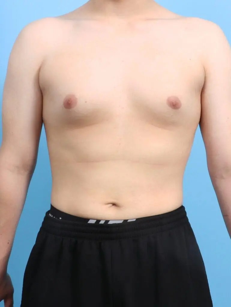 Gynecomastia - Case 24494 - Before